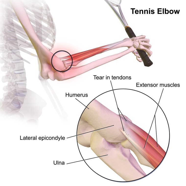 Elbow showing inflamed tendon attachment