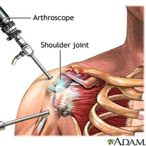 Arthroscopic Surgery and What You Can Expect