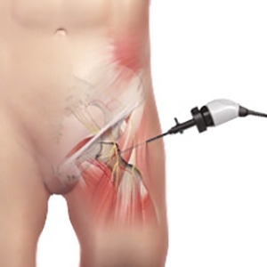 Hip Arthroscopy