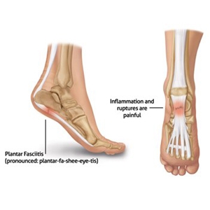 Managing Common Heel Pain