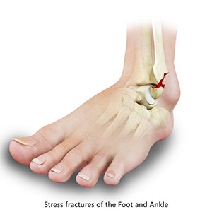 Stress Fractures