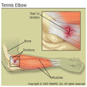 What You Need to Know About Tennis Elbow