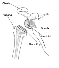 Shoulder Replacement2