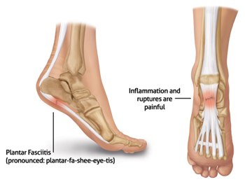 Managing Common Heel Pain