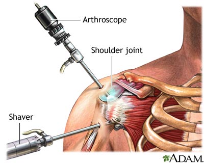 Arthroscopic Surgery