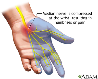 Managing Hand Pain